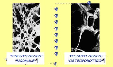 Osso NORMALE ed osso con OSTEOPOROSI