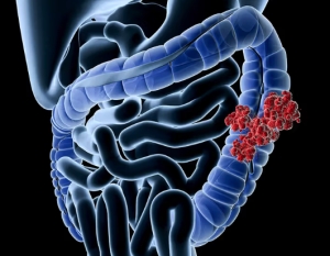 Lotta al cancro del colon retto: in Puglia cresce l’adesione allo screening salvavita
